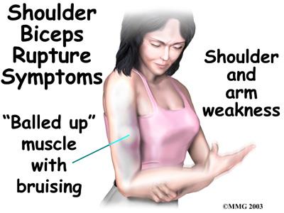 A rupture of the biceps tendon can happen from a seemingly minor injury. When it happens for no apparent reason, the rupture is called nontraumatic.