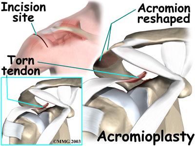 Some surgeons will also sever the corocohumeral ligament, which arches over the top of the shoulder joint.