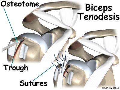 subacromial decompression. The ruptured end of the biceps is then anchored to the upper end of the humerus. This is called direct tenodesis.
