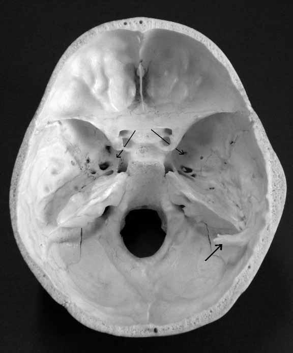 M. Sharma, B. Singh, A. Abhaya and H. Kumar Fig. 1. Skull I: Interior of skull. Thin arrows: bilateral presence of carotidoclinoid foramen. Thick arrow: dural spur. Fig. 2.