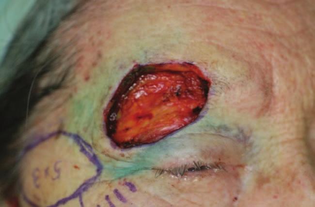7 3.7 1.4 0.9 4 46 Female Skin metastasis of breast cancer 2.5 3.5 1.5 0.8 5 86 Male Basal cell carcinoma 3.5 5.1 1.7 1.1 6 79 Female Sebaceous carcinoma 3.0 5.0 1.8 1.3 *All flaps survived in total.