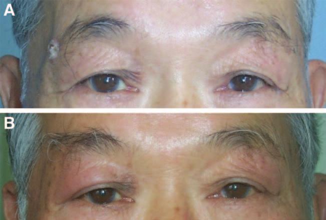 PRS GO 2014 Fig. 5. Pre- and postoperative photographs of a 67-year-old man with squamous cell carcinoma involving the right lateral eyebrow (patient 1). A, A 1.0 1.