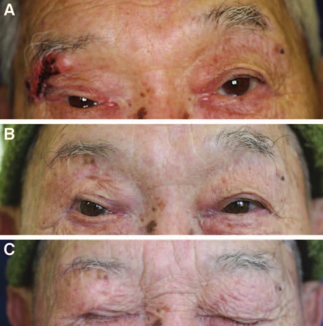 Photographs of an 86-year-old man (patient 5) with basal cell carcinoma involving the right lateral eyebrow and upper eyelid. A, Appearance of the tumor on a preoperative frontal photograph.