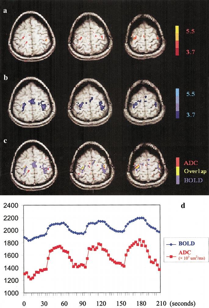 fmri WITH ENHANCED SPATIAL LOCALIZATION 745 FIG. 3. Functional activation based on ADC, BOLD, and their activation overlap.