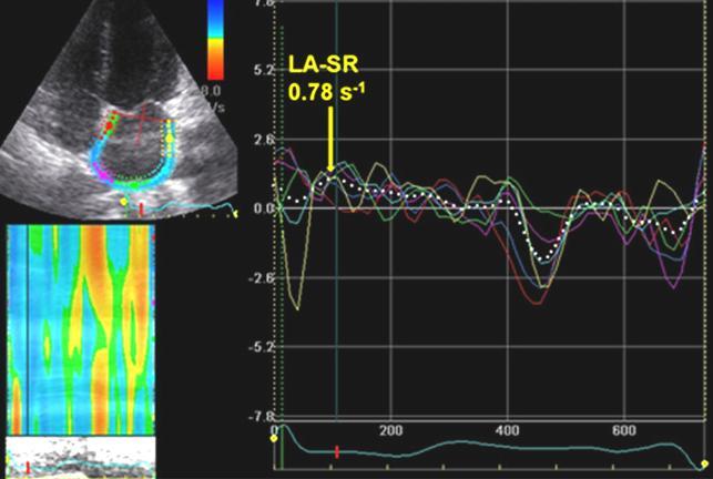 LA function by speckle-tracking echocardiography HFpEF LA expansion Asymptomatic LVDD LA expansion LA systole LA systole LA function