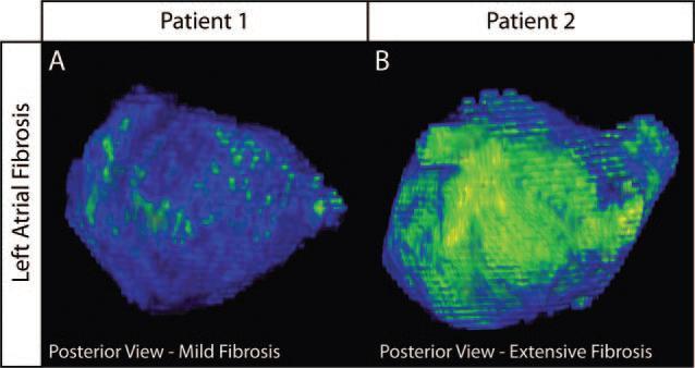 Areas with decreased LA strain correspond to LA wall fibrosis LA strain velocity vector