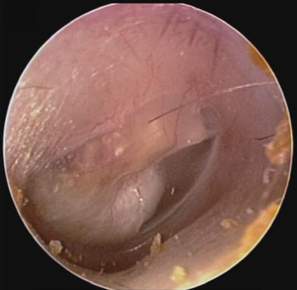 Park JH et al. Endoscopic Congenital Cholesteatoma Surgery page 5 of 9 Frequency (Hz) 125 250 500 1 K 2 K 4 K 8 K A Hearing level (db) 10 0 10 20 30 40 50 60 70 80 90 100 110 120 130 B C D Fig. 2. Preoperative findings in case 13.