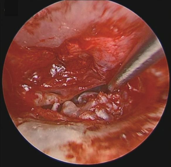 (B) The cholesteatoma was too large to remove en bloc, so it was opened and reduced in size by removing inner keratin debris.