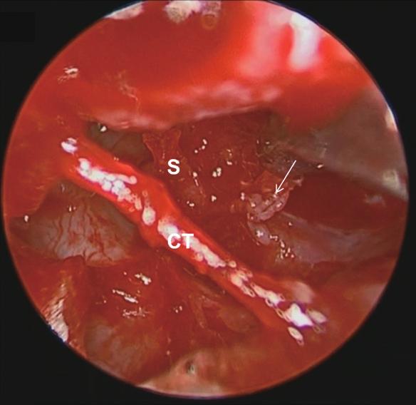 Conventional microscopic surgical views are often limited in visualizing the surroundings of CCs, especially they have adhered to the middle ear mucosa and posterior tympanum.