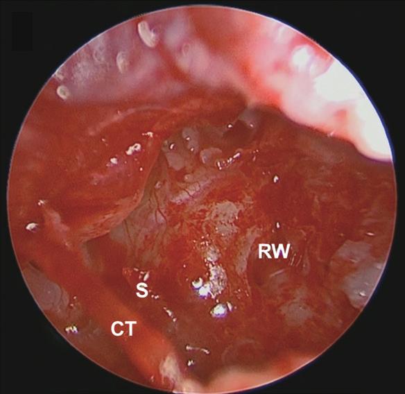 For complete removal of more extensive CCs, more invasive procedures such as removing the ossicles and resecting the bony external auditory canal are often necessary in microscopic surgeries [26].
