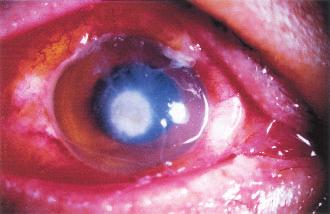 34 L. XIE ET AL. the development of fungal keratitis. The approximate time between the day of infection and diagnosis was between 13 days and 3 months, with a mean of 26.5 days.