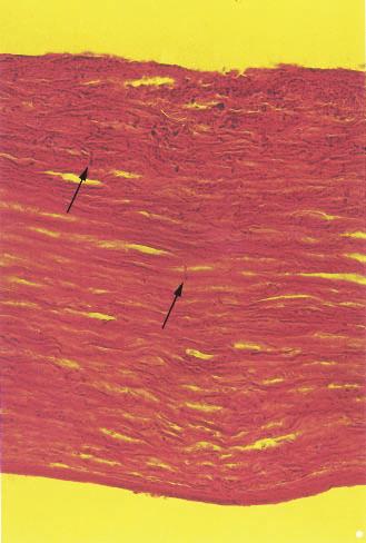LAMELLAR KERATOPLASTY AND FUNGAL KERATITIS 35 Histopathologic examination of the surgical specimens after PAS staining revealed fungal hyphae in all specimens.