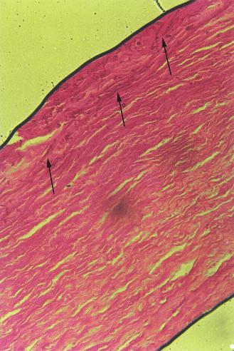 There was a tendency for the hyphae of the Aspergillus to grow perpendicular to the orientation of the corneal stromal layers (Fig. 3).