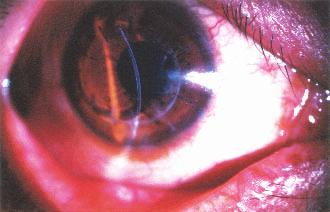 Immune rejection was not observed in any of the LKP patients and the grafts remained clear during follow-up. DISCUSSION FIG. 2. Slit lamp photograph of the cornea shown in Fig. 1 after LKP.