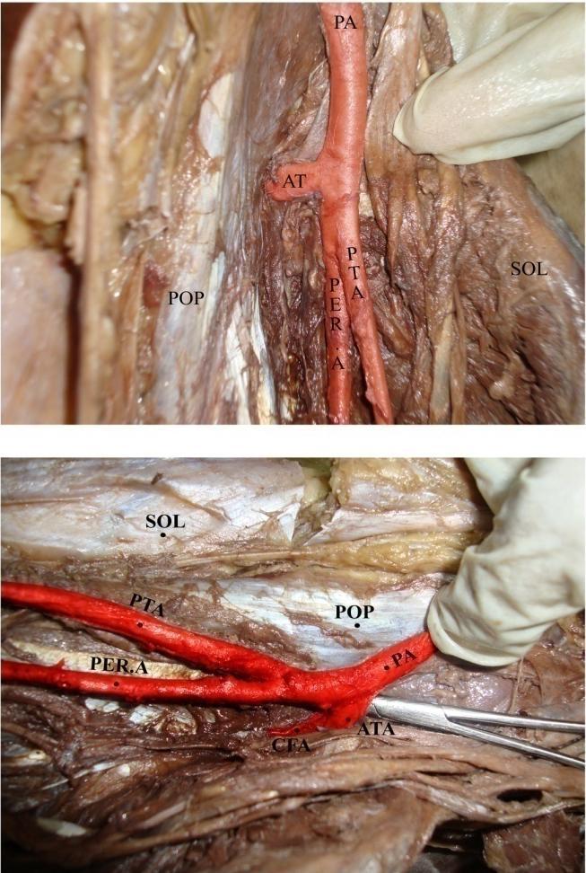 PICTURE-4 & 4a TRIFURCATION PATTERN In one specimen [2.5%] the popliteal artery at the lower border of popliteus muscle had given 2 branches.