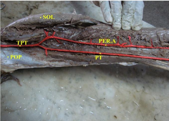 In upper 2/3 rd of leg, the artery was superficially covered by soleus. In the posterior surface of tibia the artery was superficially covered by fasciae and skin.