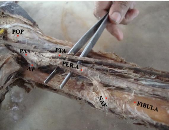PICTURE-9 PTA SMALLER IN SIZE The posterior tibial artery was absent in 1 specimen [2.