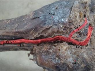 posterior tibial artery was terminated by dividing into medial and lateral plantar arteries. B.