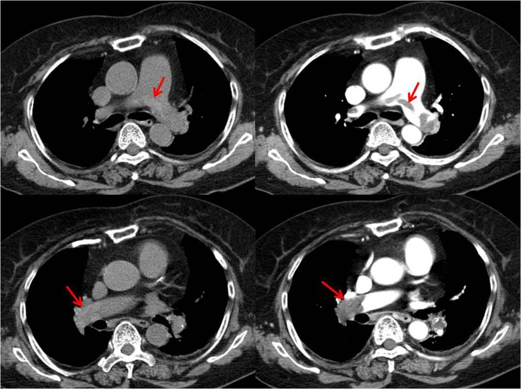 Fig. 1: Pulmonary embolism in main pulmonary artery.