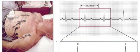 Electrocardiogram (ECG or EKG)-Looks at depolarization & re-polarization of the heart P-wave: depolarization of the atria QRS
