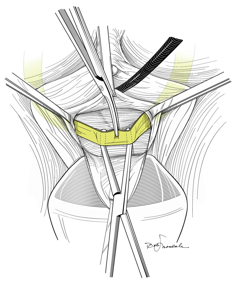 Pubovaginal Sling Lysis Inverted U or midline incision