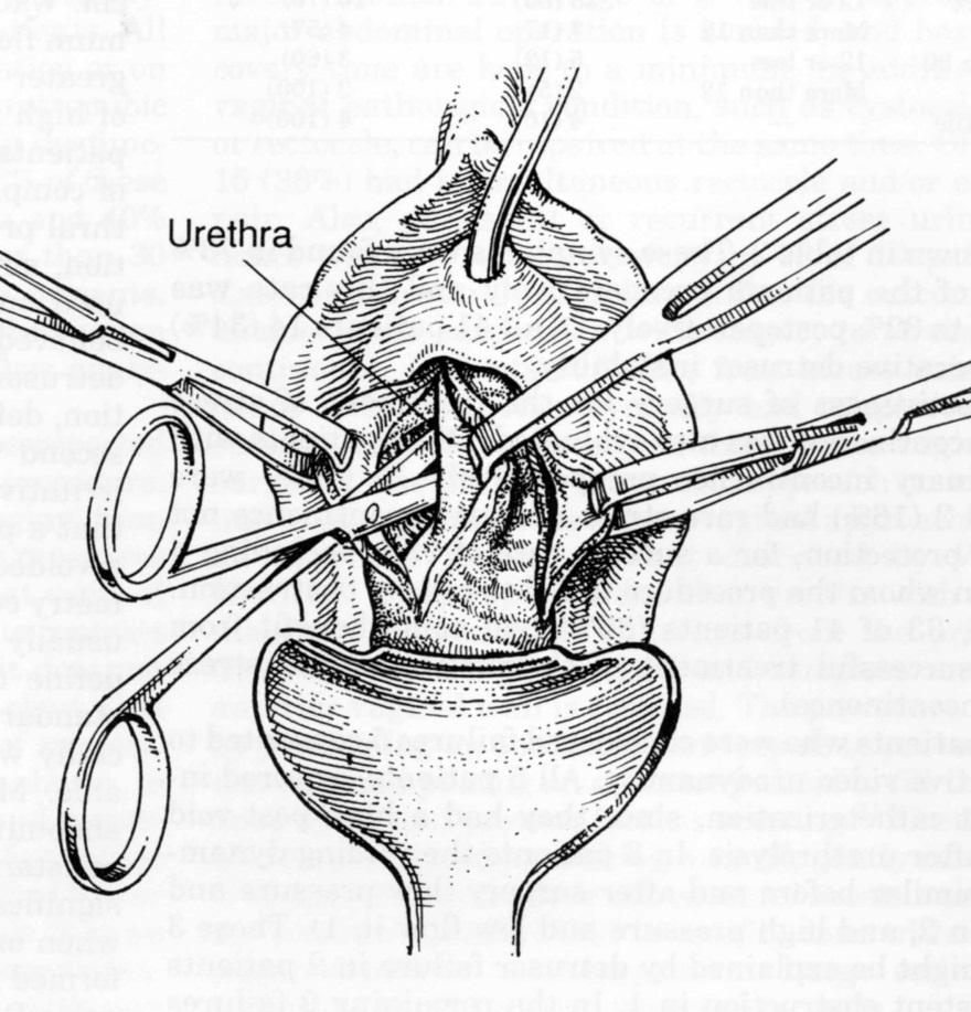 Transvaginal Urethrolysis Sharp and blunt dissection freeing the urethra from the