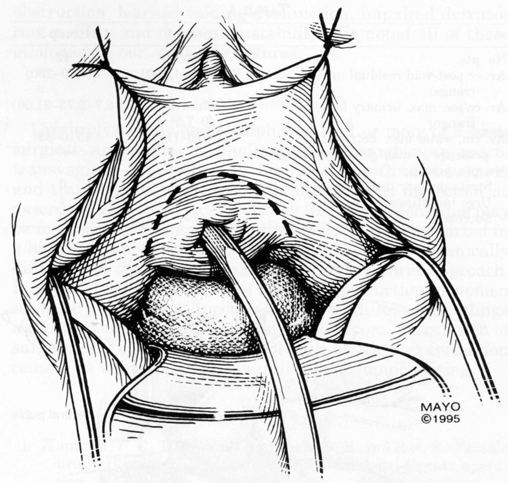 Suprameatal Urethrolysis