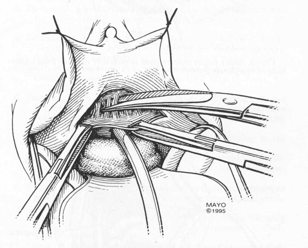 Suprameatal Urethrolysis Sharp dissection of urethra and bladder neck off pubic bone Pubourethral,
