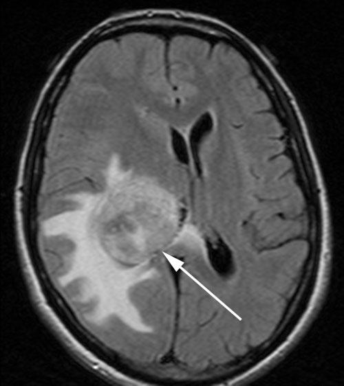 Intrventriculr CNS lesions Centrl neurocytoms re well-differentited (WHO grde II) neoplsms nd constitute pproximtely 0.25 0.5% of ll intrcrnil tumours.