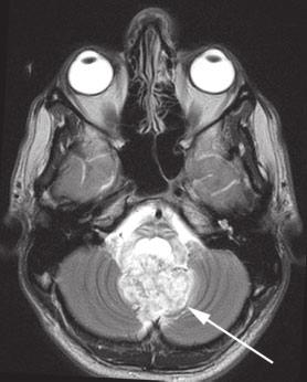J Wtts et l. c Fig. 10. MRI of 20-yer-old mle with choroid plexus ppillom (rrows) of the fourth ventricle.