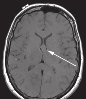 Intrventriculr CNS lesions Fig. 13. MRI of 56-yer-old womn with n incidentl third ventriculr colloid cyst.