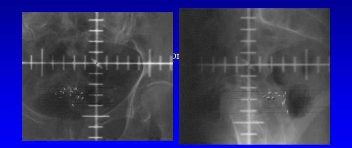 Orthogonal Radiographs of an Interstitial