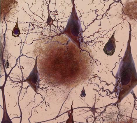 Brain Cells in Alzheimer s Disease Become Dysfunctional Abnormal proteins form