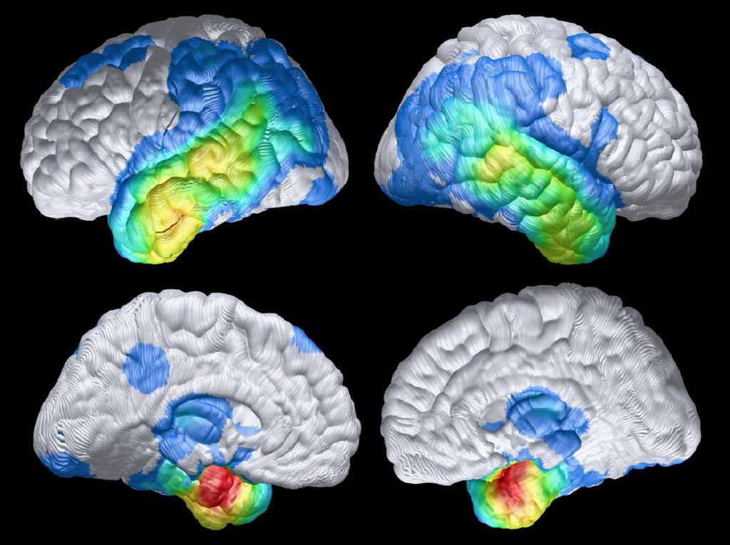 Brain Scan Differences in Alzheimer s Disease and Healthy Aging MRI scans showing less brain volume in