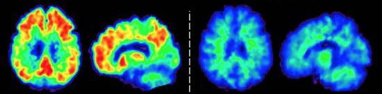 Brain Scan Differences in Alzheimer s Disease and Healthy Aging Alzheimer s Disease Healthy Aging Brain Amyloid Imaging Brain Glucose Imaging Brain PET scans