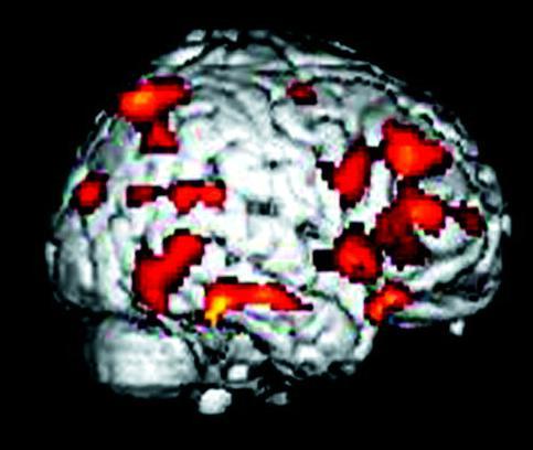 Brain Scans Show Decline in Alzheimer s Disease Alzheimer s Disease at Baseline