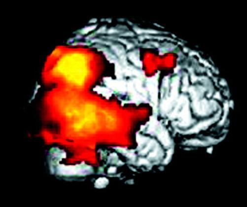 brain areas that extend beyond baseline differences between patients with