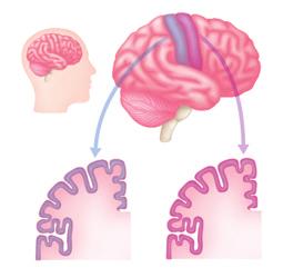PARKINSON S DISEASE Sense and movement Each side of the brain has its own sensory and motor cortices which sense touch and control movement in the opposite side of the body.