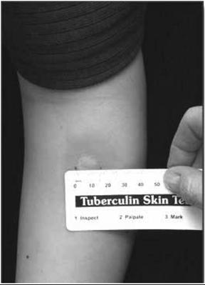 Reading the TST Measure reaction in 48 to 72 hours Measure induration, not erythema Record reaction in millimeters, not as negative or positive Positive reactions can be read for up to 7 days