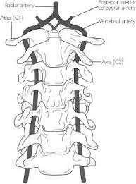 Caused by compression of the vertebral artery by the combined actions "