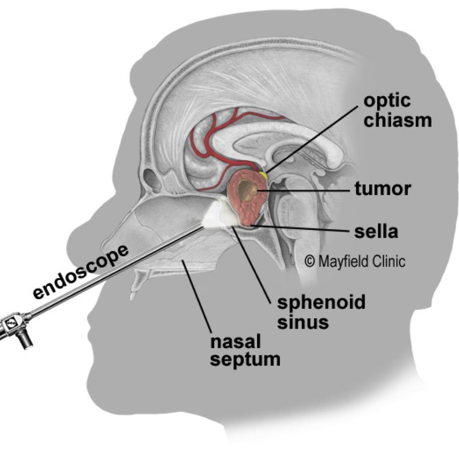 Endoscopic Pituitary Surgery (transsphenoidal) Overview Endoscopic surgery is performed through the nose to remove tumors from the pituitary gland and skull base.