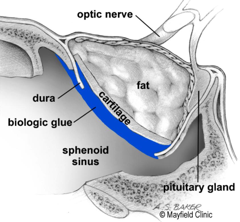 A small portion of the nasal septum dividing the left and right nostril is removed. Using bone-biting instruments, the front wall of the sphenoid sinus is opened (Fig. 3).