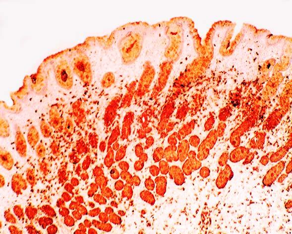 Figure 3. Chronic gastritis (antrum) showing similar lysozyme as in Figure 1.