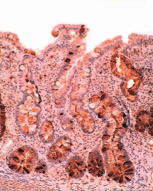 It should be stressed, however, that the lysozyme antibody used by Saito et al. [11] more than 21 years ago and by Santini et al. Figure 4. Intestinal metaplasia (corpus).