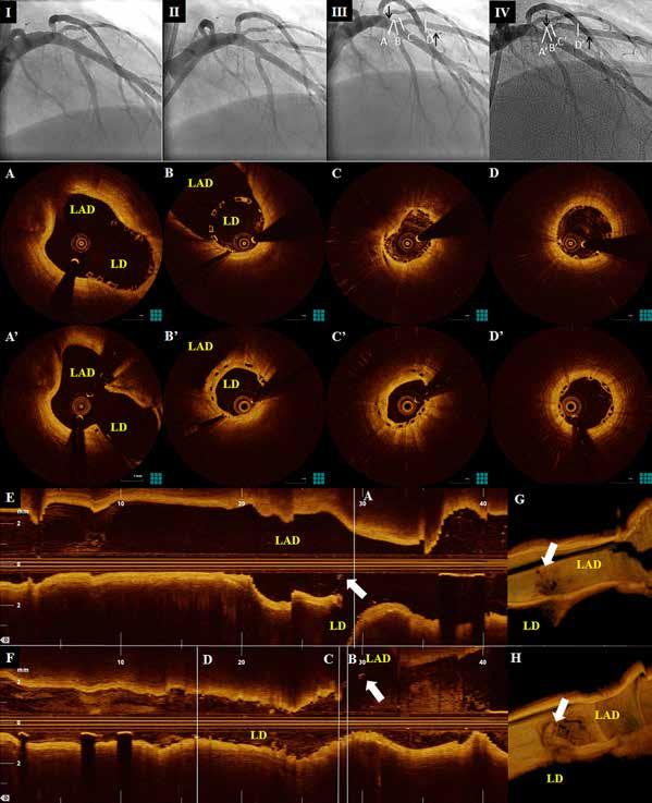 A. Karanasos et al Figure 5. Top panels: Coronary angiography demonstrating (I) total occlusion of the LD, and the angiographic result after (II) 2.0 mm balloon predilation and (III) 2.