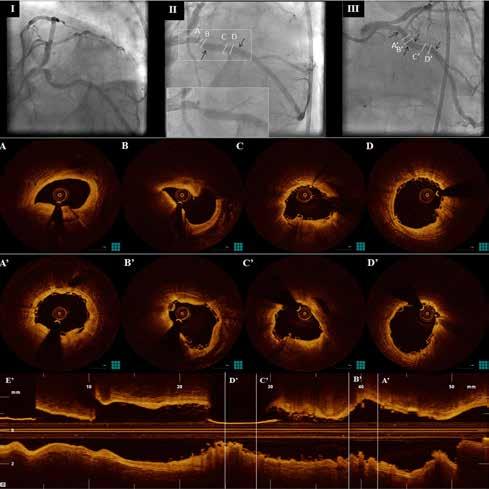 OCT After Bioresorbable Vascular Scaffold Implantation Figure 2. Top panels: Coronary angiography demonstrating the left circumflex artery lesion (I) pre-intervention, and (II) after 3.