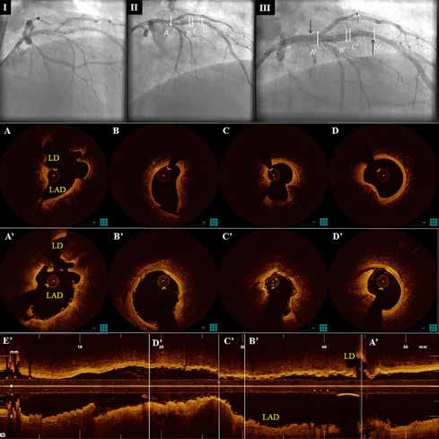 A. Karanasos et al Figure 3. Top panels: Coronary angiography demonstrating the LAD lesion (I) pre-intervention, (II) after 3.0 mm balloon dilation, and (III) after 3.