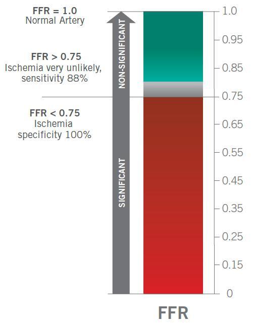 Significant or not? The reduction in myocardial blood flow by a stenosis, as indicated by FFR, can be closely correlated to Ischemia. FFR = 1.0 Normal artery FFR > 0.75 FFR < 0.