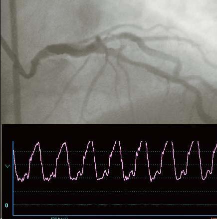 Left Main Stenosis Surgery or not?
