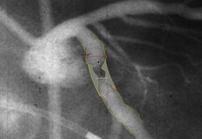 excess stenting Imaging modalities do not take into account collateral flow or
